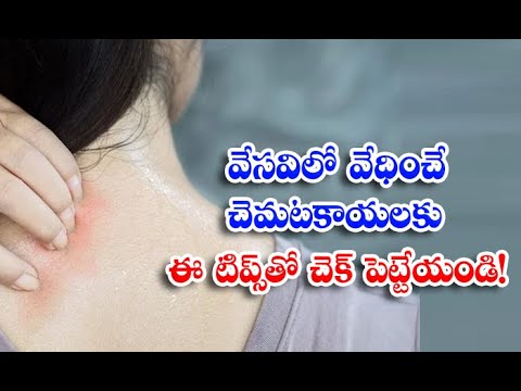  Home Remedies, Reduce Heat Rashes, Heat Rashes, Latest News, Summer Tips, Summer-TeluguStop.com