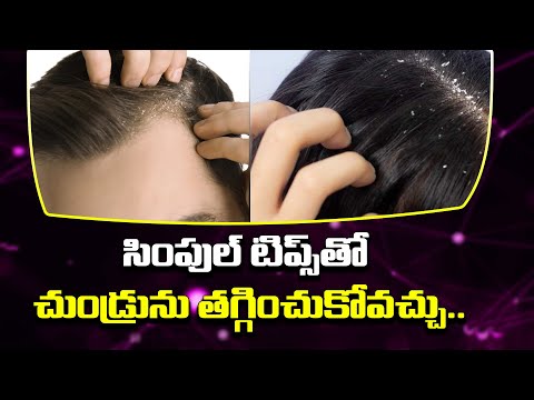  Amazing Home Remedies To Get Rid Of Dandruff-TeluguStop.com