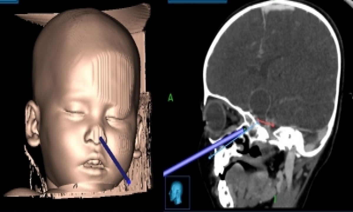  World’s Youngest Large Brain Tumour Patient Operated On In Chandigarh-TeluguStop.com