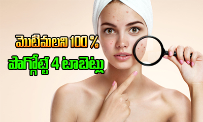  4 Tablets For 100% Acne Treatment-TeluguStop.com