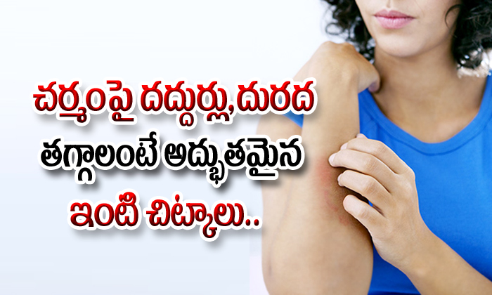  Home Remedies For Hives And Irritation-TeluguStop.com