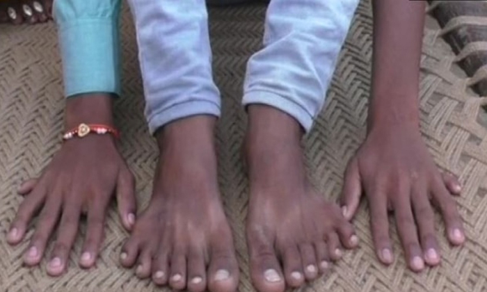  Up Boy Has 12 Fingers 12 Toes Relatives Want Him Dead-TeluguStop.com