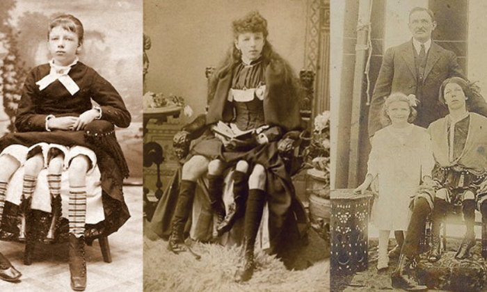  Myrtle Corbin Was A Four Legged Woman Who Had Five Kids-TeluguStop.com