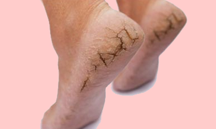  Feet Cracks, Health Tips, Home Remedies For Feet Cracks, Telugu Health Tips-TeluguStop.com