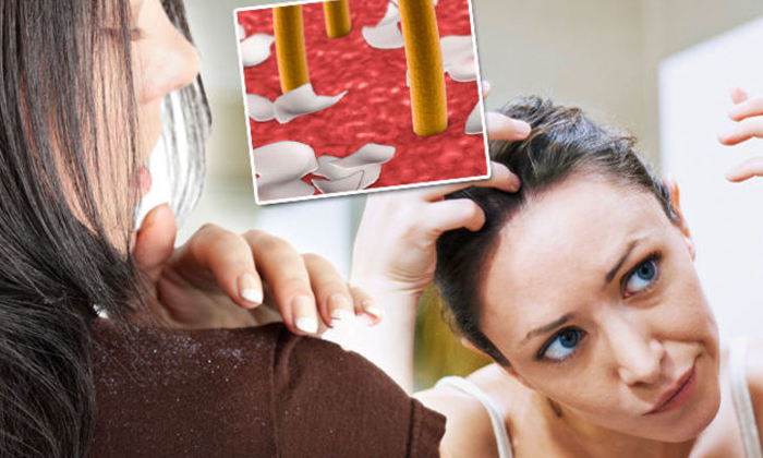  The 5 Mistakes To Avoid For Dandruff Sufferers, Hair Care, Dandruff Tips, Hair T-TeluguStop.com