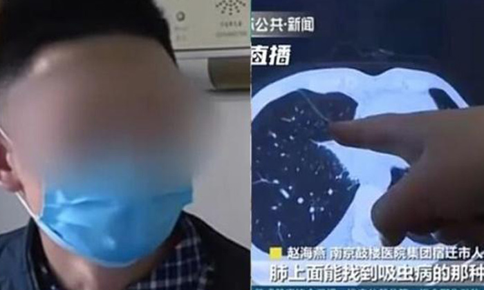  Chinese Man, Raw Snakes, Paragonimiasis, Lungs, Worms, Breathing Difficulty-TeluguStop.com