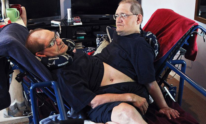  World's Longest Surviving Conjoined Twin Brothers, Death, America, Conjoined Twi-TeluguStop.com