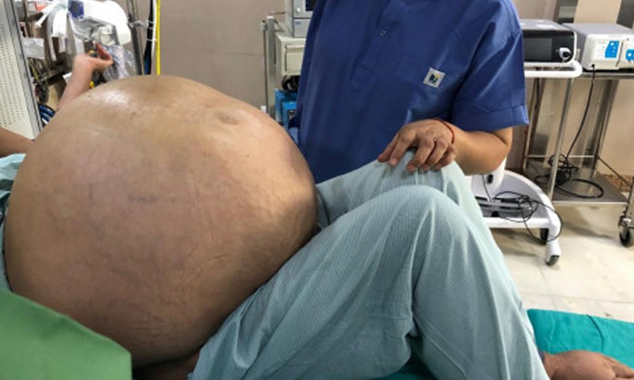  50kgs Tumor Found In Woman Stomach,delhi, Tumor, Stomach, Operation, Heavy Weigh-TeluguStop.com