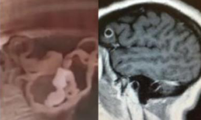  5 Inch Worm In Man's Brain For 17 Years, Live Worm, Brain, Chinese Man, Losses B-TeluguStop.com