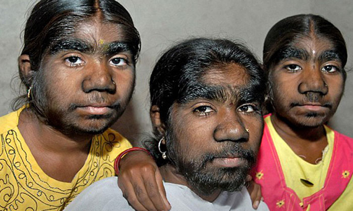  Sindrom, Dicease, Sisters, Hair, Body, Three Indian Sisters Suffering From A Rar-TeluguStop.com