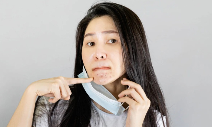  Treat Acne Caused By Face Masks  Treat Acne, Face Masks, Beauty Tips, Coronaviru-TeluguStop.com