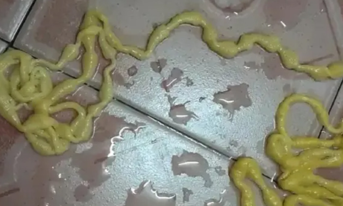  Thailand Man Suffering From Severe Stomach Ache Pulls Out 17 Ft Yellow Tapeworm-TeluguStop.com