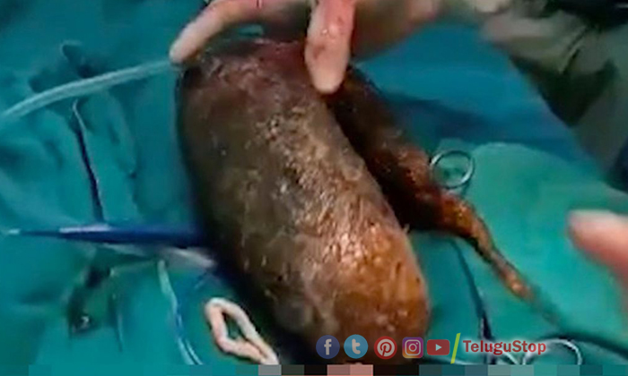  Doctors Removed 7kgs Hair Clup From Woman Body, Hair, Girl Ate Hair, Doctors, Jh-TeluguStop.com