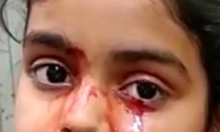  Girl In India Cries Tears Of Blood In Rare Medical Anomaly, Rare Medical Anomaly-TeluguStop.com