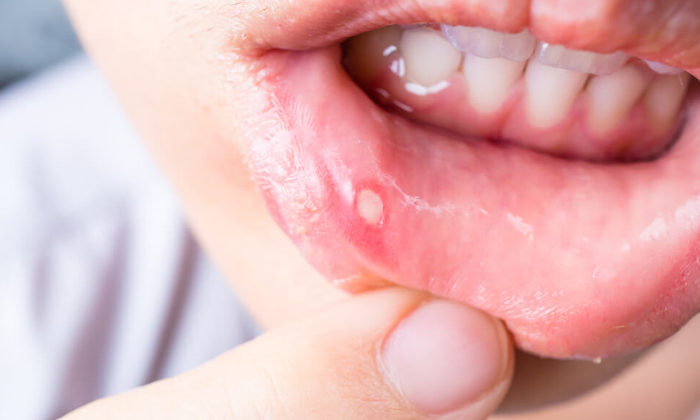  How To Get Rid Of A Mouth Ulcer Quickly! Mouth Ulcer, Latest News, Health Tips,-TeluguStop.com