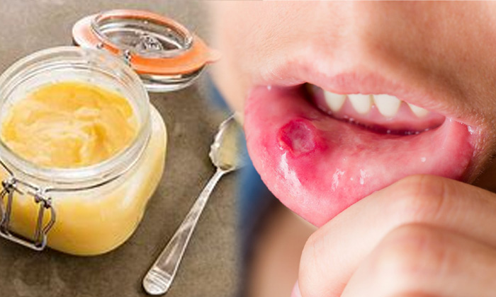  Ghee Helps To Reduce Mouth Ulcer Ghee, Reduce Mouth Ulcer, Mouth Ulcer,home Redi-TeluguStop.com