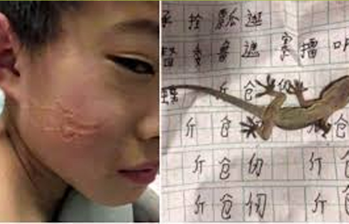  Viral Photo Lizard Mold On Boys Cheek What Is The Real Meaning, Viral Photo, Liz-TeluguStop.com