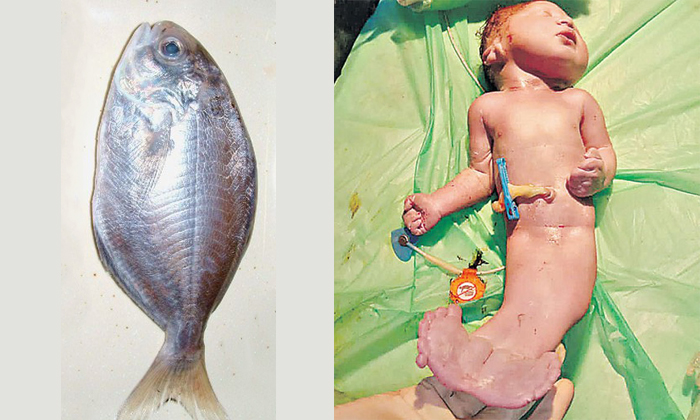  Baby Born In The Shape Of A Fish In Petlaburuju Hospital Hyderabad ,fish, Petlab-TeluguStop.com