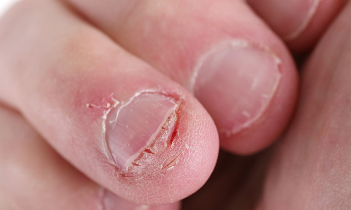  You Will Face These Problems If You Have Nail Biting Habit , Nails Biting, Habit-TeluguStop.com