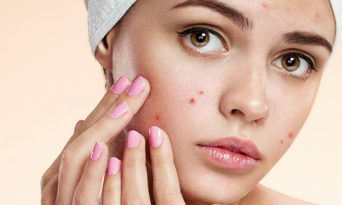  How To Get Rid Of Pimples During Periods! Pimples During Periods, Pimples, Women-TeluguStop.com