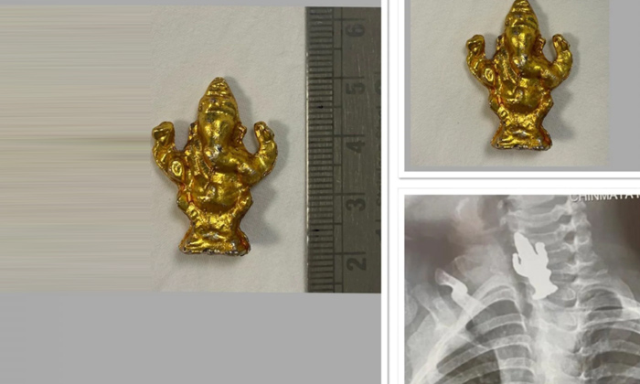  Three Year Old Baby Swallowed Ganesh Idol In Bangalore, Ganesh Idol ,bangalore,-TeluguStop.com