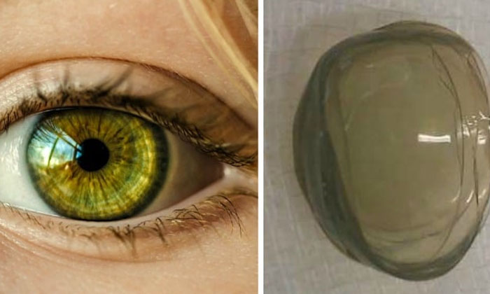  Uk Surgeon Finds 27 Missing Contact Lenses In Woman’s Eye, Contact Lenses Stuc-TeluguStop.com