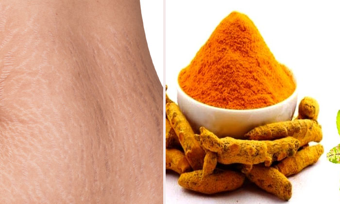  Turmeric Powder Helps To Reduce Stretch Marks! Turmeric Powder, Reduce Stretch M-TeluguStop.com