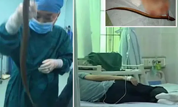  Viral: The Person Who Sent The Eel Into The Body Through The Anus Finally, Viral-TeluguStop.com