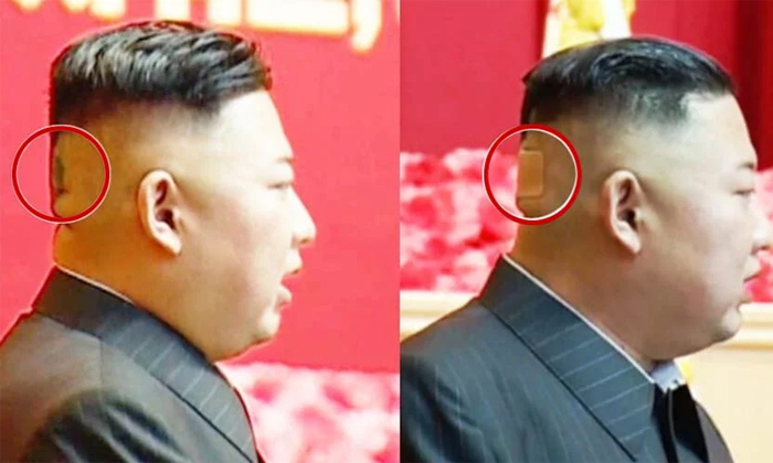  Photos Viral North Korea Kim Jong Un Photos Viral With A Band On Neck What Happe-TeluguStop.com