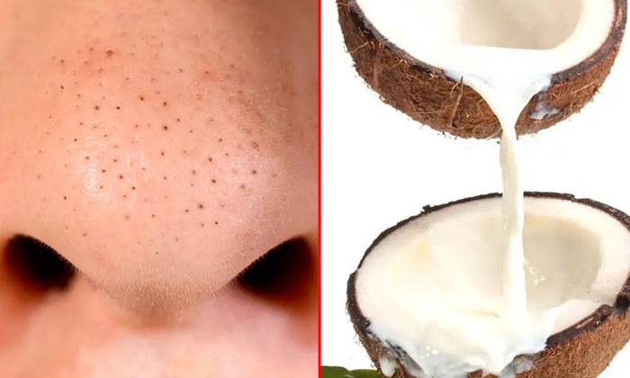  Coconut Milk Helps To Reduce Blackheads Naturally! Coconut Milk, Blackheads, Bea-TeluguStop.com