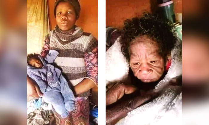  South Afican Child Suffering From Rear Disease Of Looking Old From Birth Itself,-TeluguStop.com