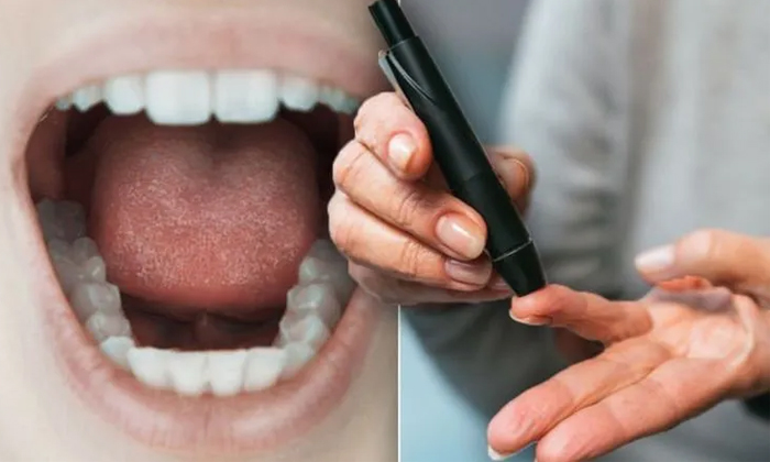  Did You Know That These Symptoms Which Appear On The Mouth Are A Sign Of Diabete-TeluguStop.com