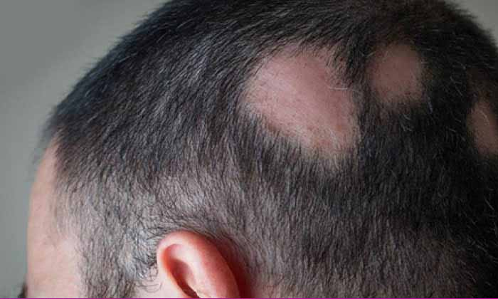  Home Remedies To Get Rid Of Lice Bite! Home Remedies, Lice Bite, Alopecia, Lates-TeluguStop.com