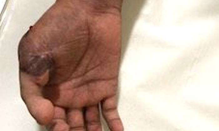  Indian Carpenter Loses Thumb In Dubai, Flies To Delhi On Time For Surgery , Indi-TeluguStop.com