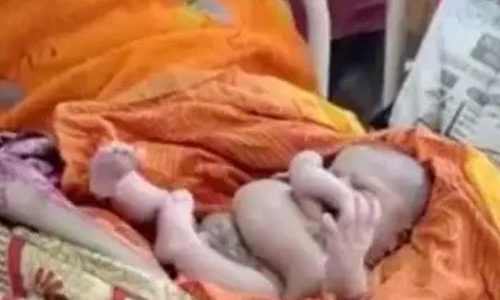  Birth Of A Newborn Baby With Four Legs And Four Arms , 4 Hands, 4 Leg, Baby Bi-TeluguStop.com