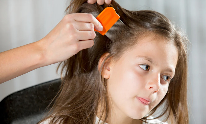  Best Ways To Remove Lice From Hair! Hair Lice, Latest News,  Remove Lice, Lice,-TeluguStop.com