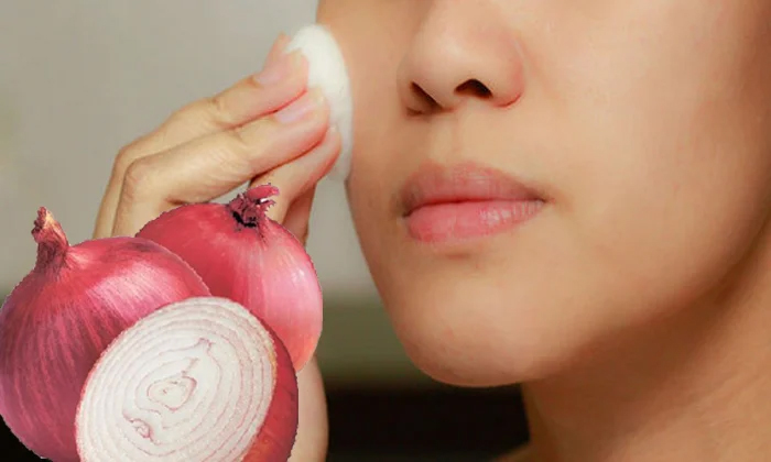  Onion Beauty Benefits And Onion Face Packs Details, Onion, Onion Beauty, Skin Ca-TeluguStop.com