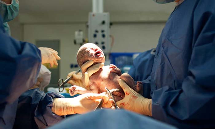  What Are The Complications Of Caesarean Section For Women , Women , C Section ,-TeluguStop.com