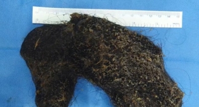  Doctors At Hyderabad Hospital Remove Hairball From Omani Girl-TeluguStop.com