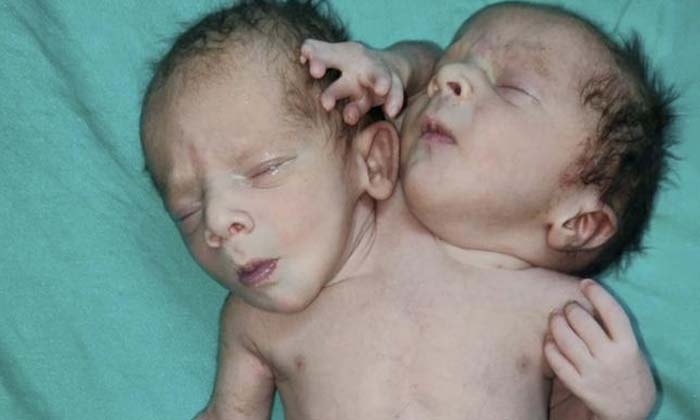  What Causes Dicephalic Parapagus Twins , Dicephalic Parapagus Twins , Newborns ,-TeluguStop.com