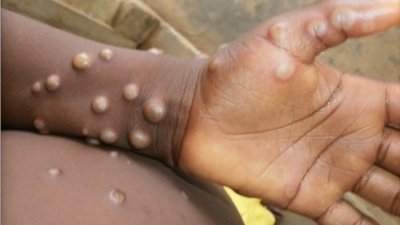  Israel, Switzerland Confirms Monkeypox Cases Amid Global Spread-TeluguStop.com