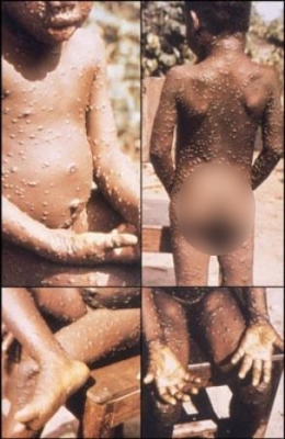  Mexico Confirms First Imported Case Of Monkeypox-TeluguStop.com