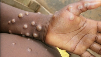  Monkeypox Cases Confirmed In 12 Countries-TeluguStop.com