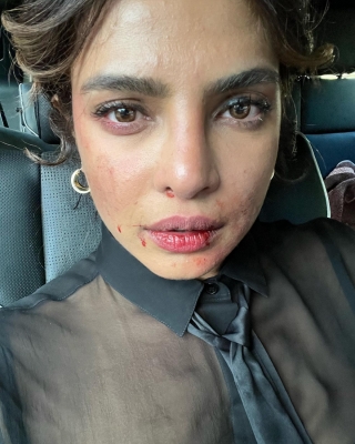  Priyanka Chopra Shares Picture Of 'bruised' Face From 'citadel' Set-TeluguStop.com