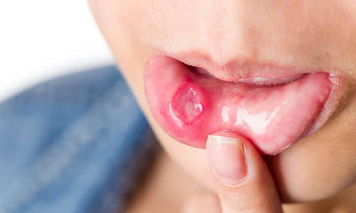  What Are The Symptoms For Oral Cancer! Symptoms For Oral Cancer, Oral Cancer, Or-TeluguStop.com