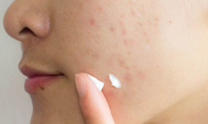  Effective Home Remedy For Acne Marks!, Home Remedy, Acne Marks, Skin Care, Skin-TeluguStop.com