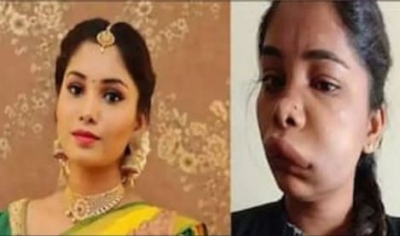  Kannada Actress Swathi's Face Swollen After Root Canal Surgery-TeluguStop.com