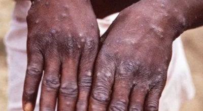  Los Angeles County Confirms First Presumptive Monkeypox Case-TeluguStop.com