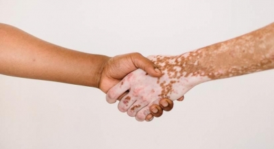  Signs To Detect Vitiligo-TeluguStop.com