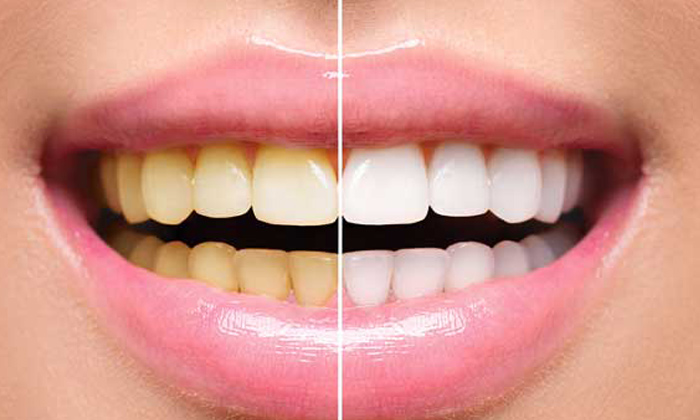 Telugu Bay, Bay Teeth, Benefits Bay, Tips, Latest, Oral, Teeth-Telugu Health Tip